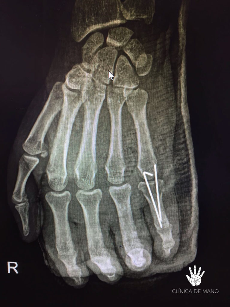 Tratamientos de Fracturas de Mano y Muñeca - Clínica de Mano