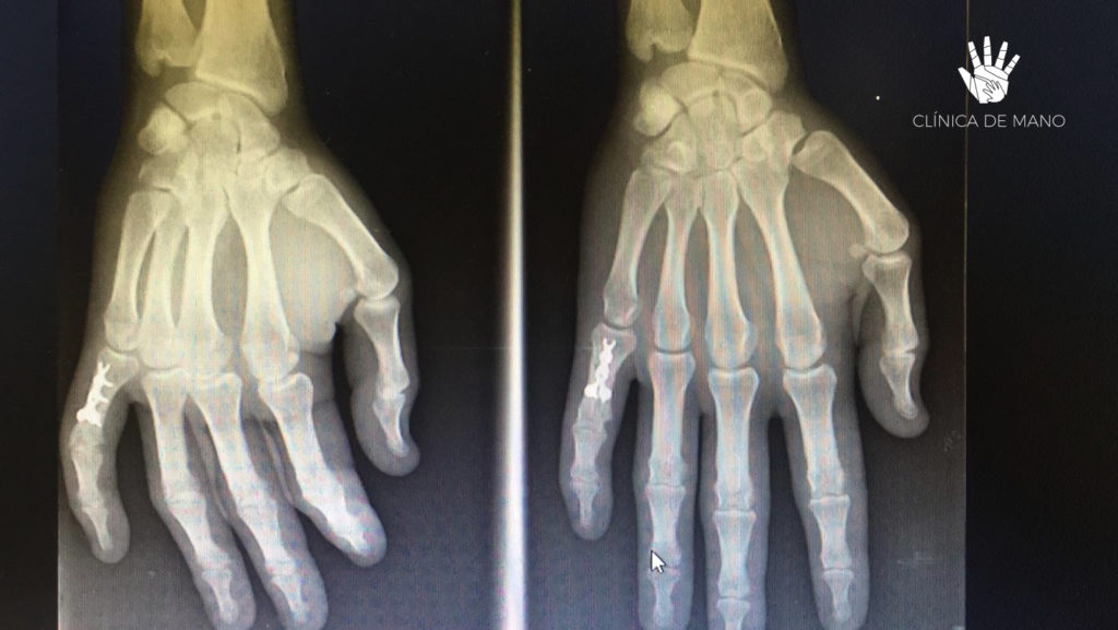 Tratamientos de Fracturas de Mano y Muñeca - Clínica de Mano