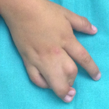 Sindactilia mano, malformación frecuente en niños